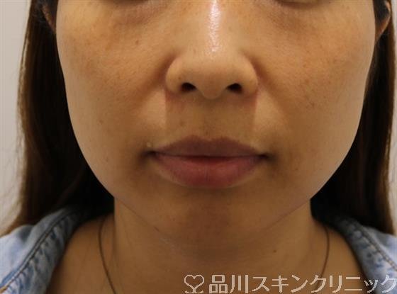 症例NO.44108のBEFORE写真