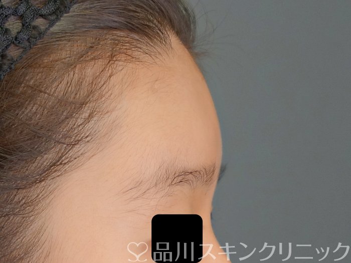 症例NO.70829のAFTER写真
