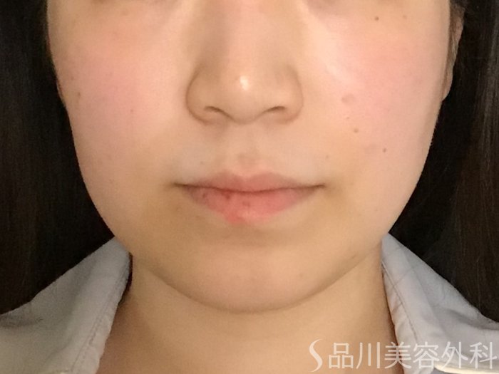 症例NO.65480のBEFORE写真