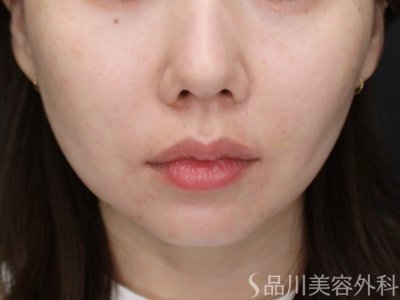 症例NO.72647のAFTER写真