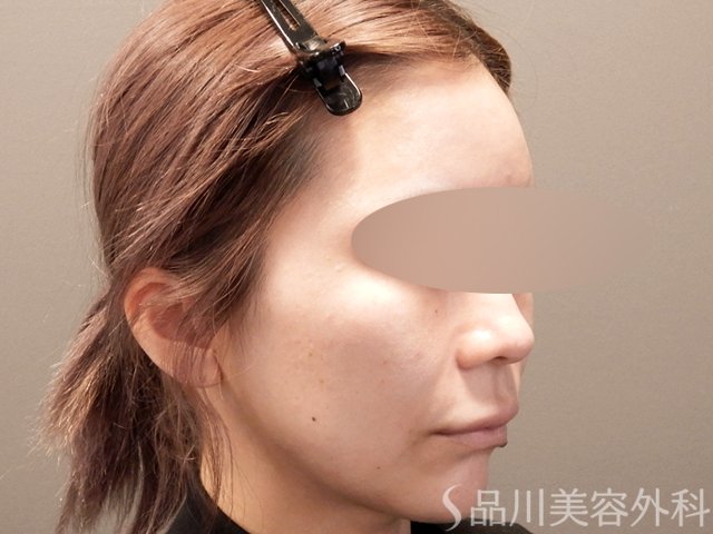症例NO.67863のBEFORE写真