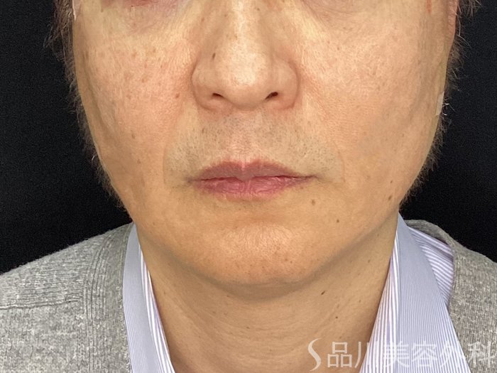 症例NO.72734のAFTER写真