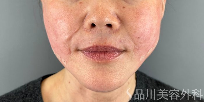 症例NO.73141のAFTER写真