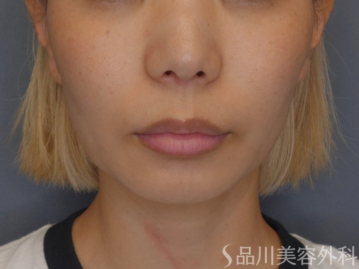 症例NO.74437のBEFORE写真