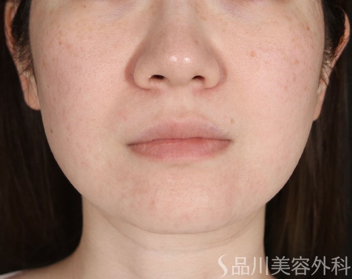 症例NO.73910のBEFORE写真