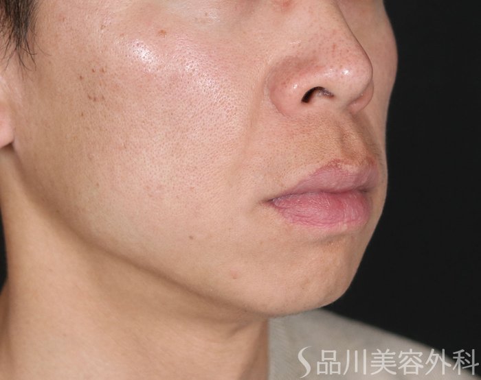 症例NO.73281のBEFORE写真