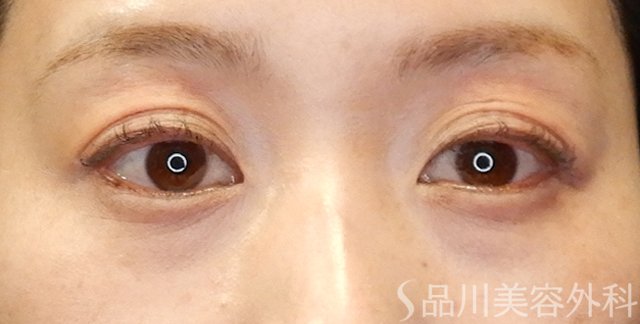 症例NO.65501のAFTER写真