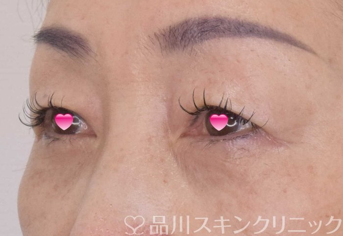 症例NO.69172のAFTER写真