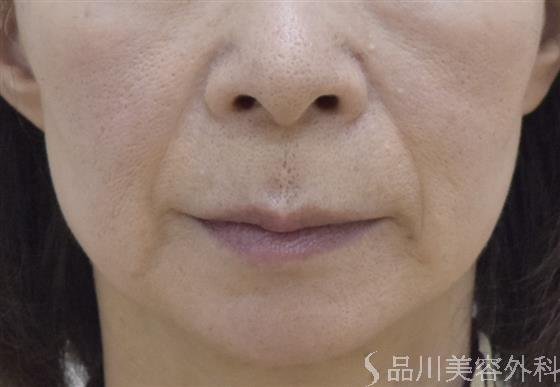 症例NO.49184のBEFORE写真