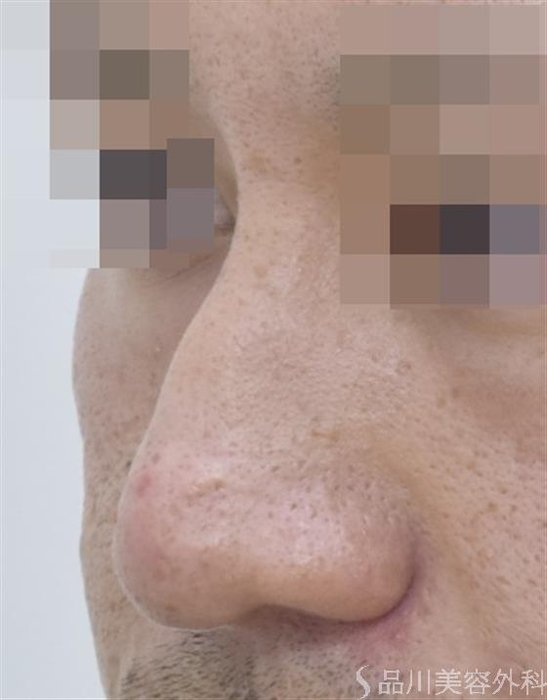 症例NO.48136のBEFORE写真