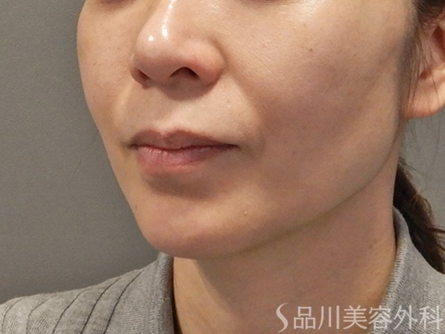 症例NO.73592のBEFORE写真