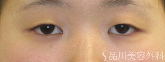症例NO.71014のBEFORE写真