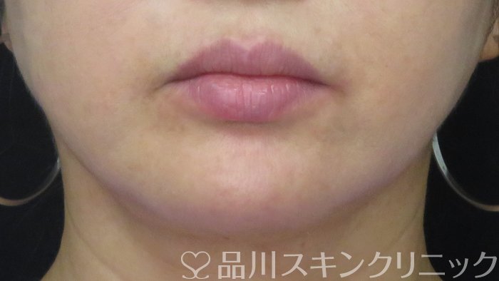 症例NO.72084のBEFORE写真