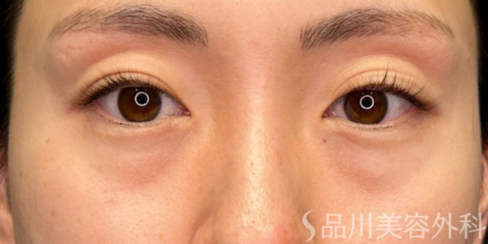 症例NO.74917のBEFORE写真