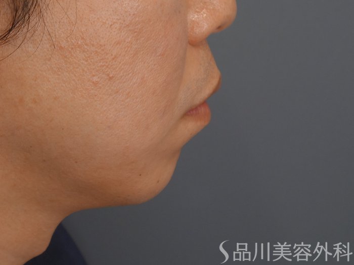 症例NO.69574のBEFORE写真