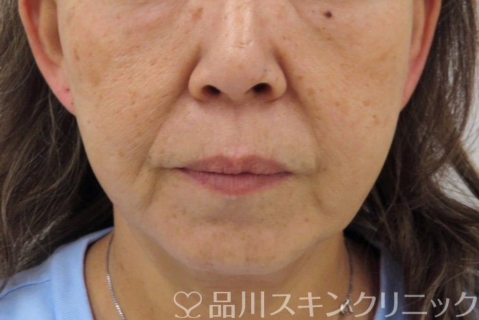 症例NO.74769のBEFORE写真