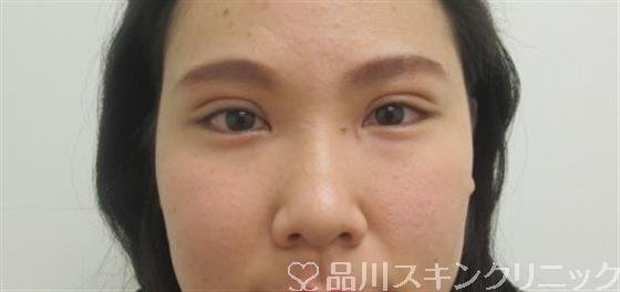 症例NO.47038のAFTER写真