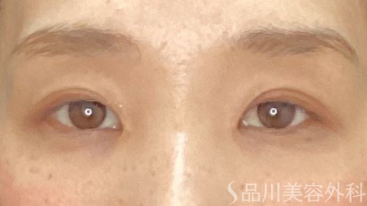 症例NO.71361のAFTER写真
