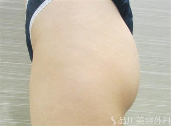 症例NO.36296のAFTER写真