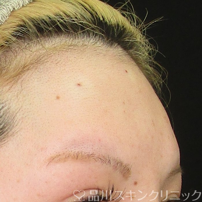 症例NO.70457のAFTER写真