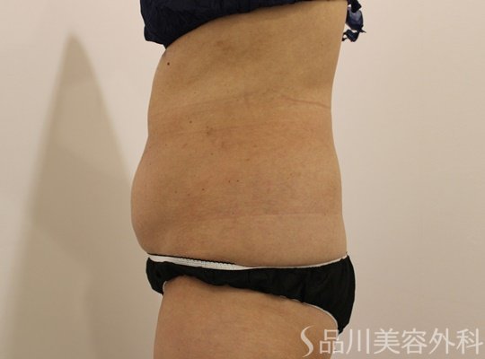 症例NO.73364のBEFORE写真