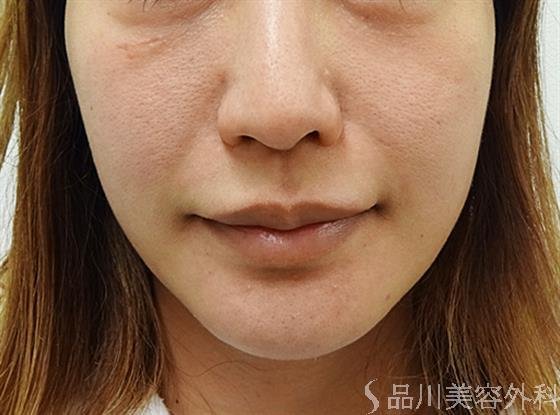 症例NO.34408のBEFORE写真