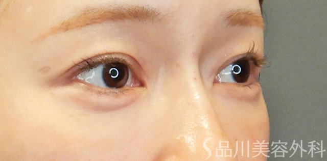 症例NO.67709のAFTER写真