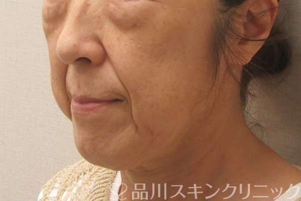 症例NO.75072のBEFORE写真