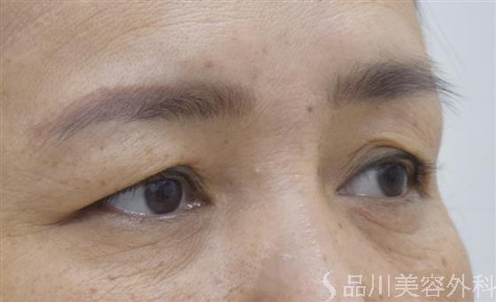 症例NO.53281のBEFORE写真