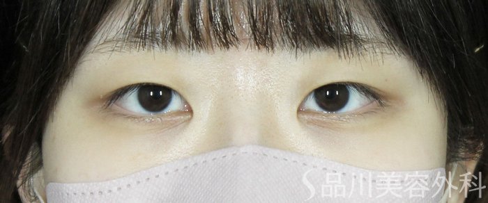症例NO.63779のBEFORE写真