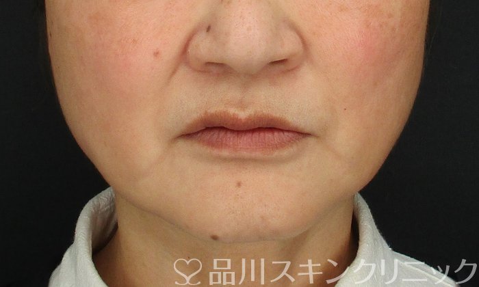 症例NO.69398のBEFORE写真