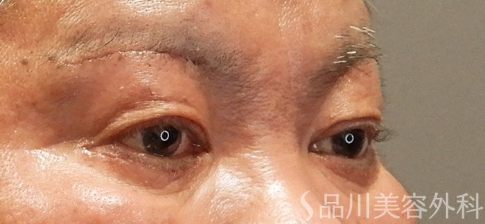 症例NO.69470のAFTER写真