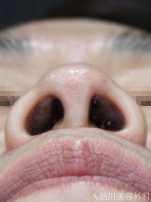 症例NO.69597のBEFORE写真