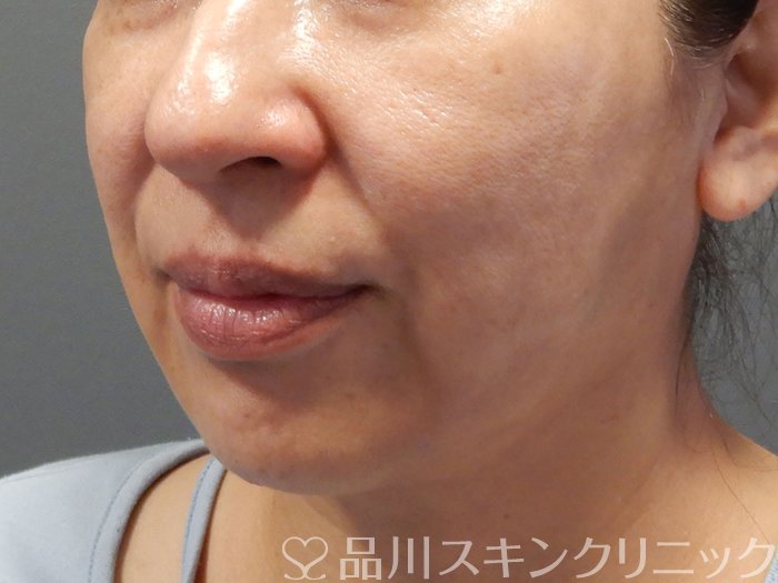 症例NO.70602のBEFORE写真