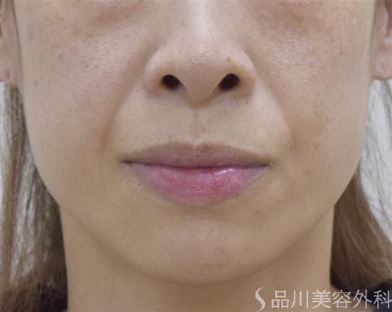 症例NO.51622のBEFORE写真