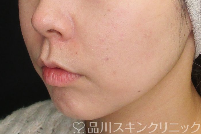 症例NO.73631のAFTER写真