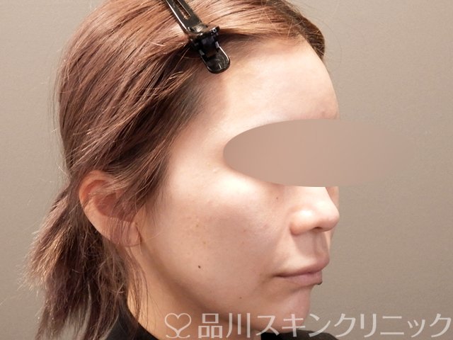 症例NO.67863のBEFORE写真