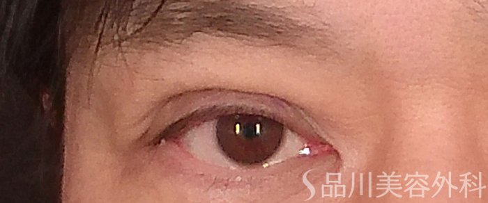 症例NO.69360のAFTER写真