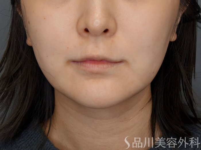 症例NO.72913のBEFORE写真