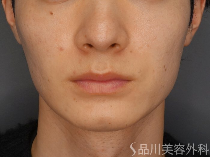 症例NO.73038のBEFORE写真