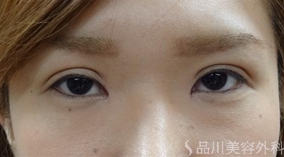症例NO.16021のAFTER写真