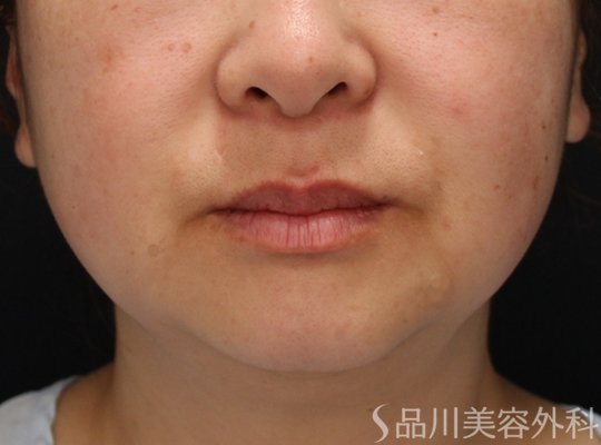 症例NO.74350のBEFORE写真