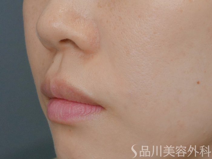 症例NO.71738のAFTER写真