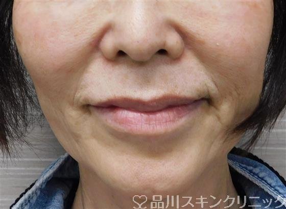 症例NO.56340のBEFORE写真