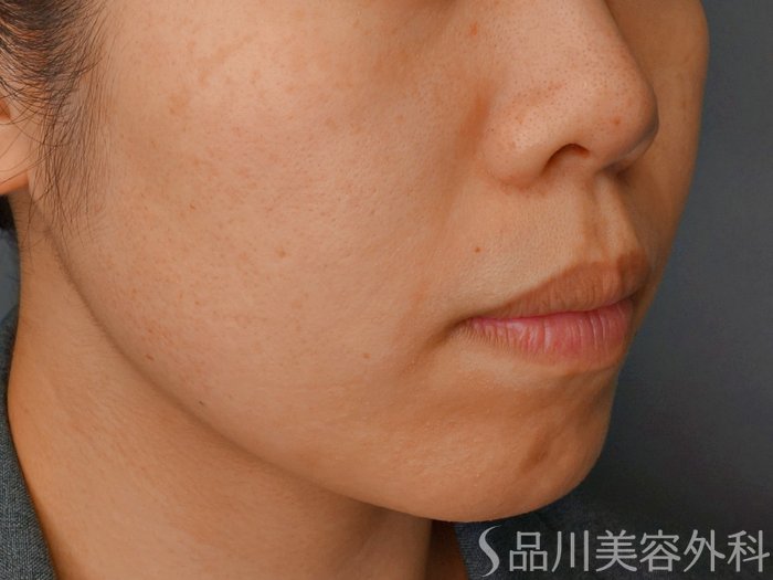 症例NO.73492のBEFORE写真