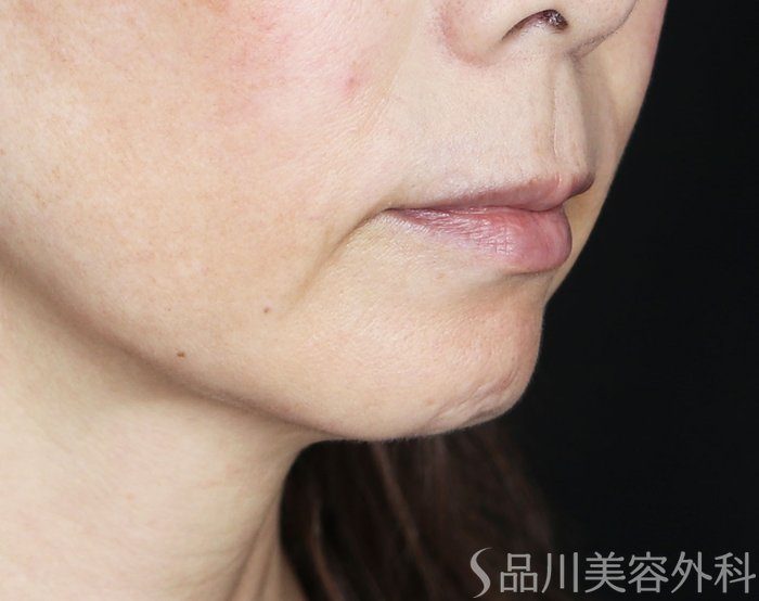 症例NO.72372のBEFORE写真