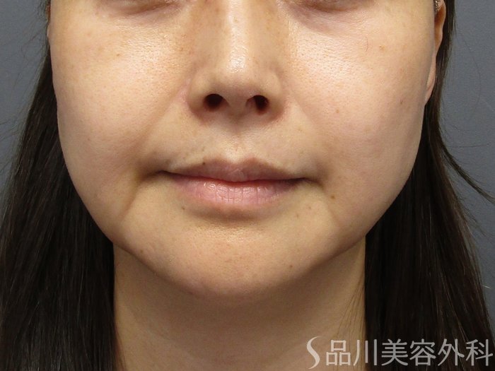 症例NO.74833のBEFORE写真