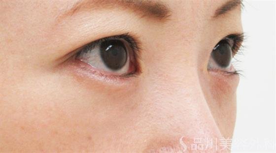 症例NO.22977のAFTER写真