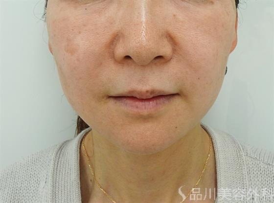 症例NO.44611のAFTER写真