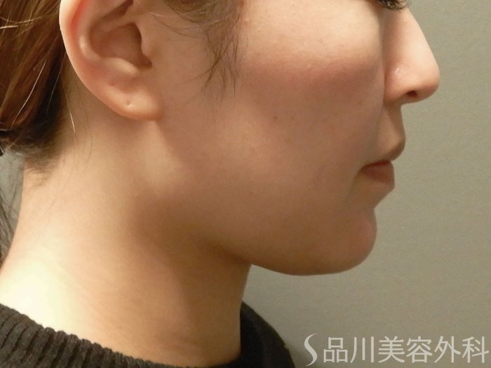 症例NO.63039のBEFORE写真